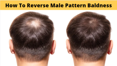 How To Reverse Male Pattern Baldness