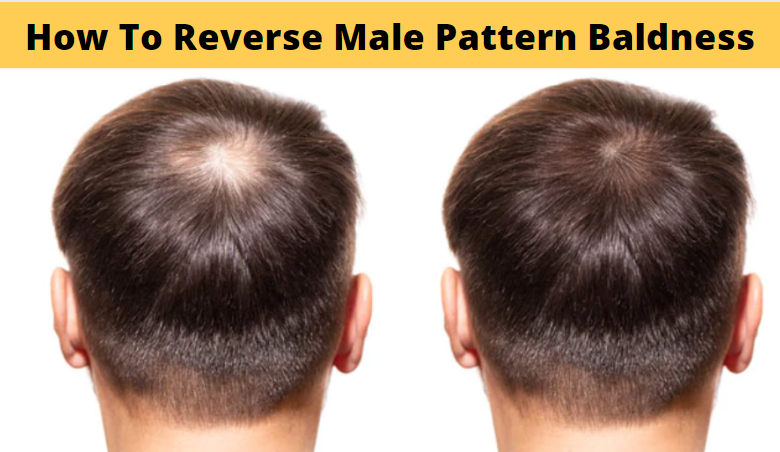 How To Reverse Male Pattern Baldness