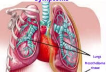 Stage 4 Mesothelioma Cancer Symptoms | Mesothelioma