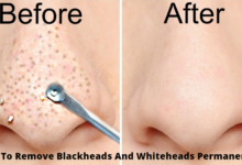 How To Remove Blackheads And Whiteheads Permanently