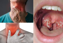 How To Cure A Sore Throat Fast